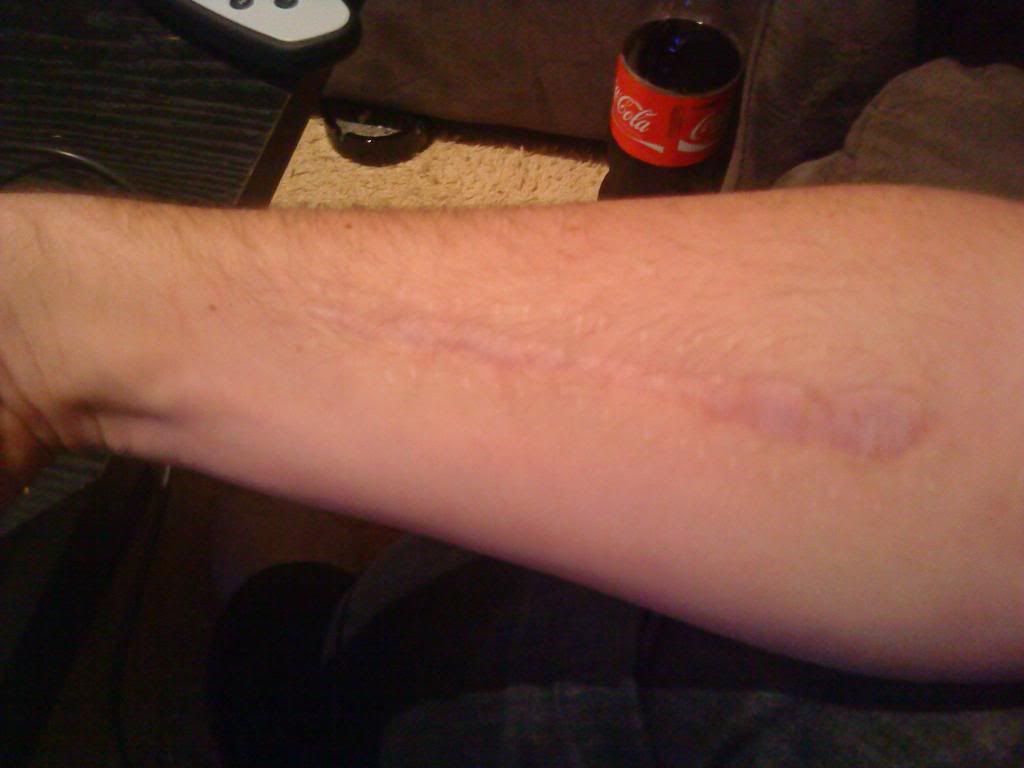 epic scar